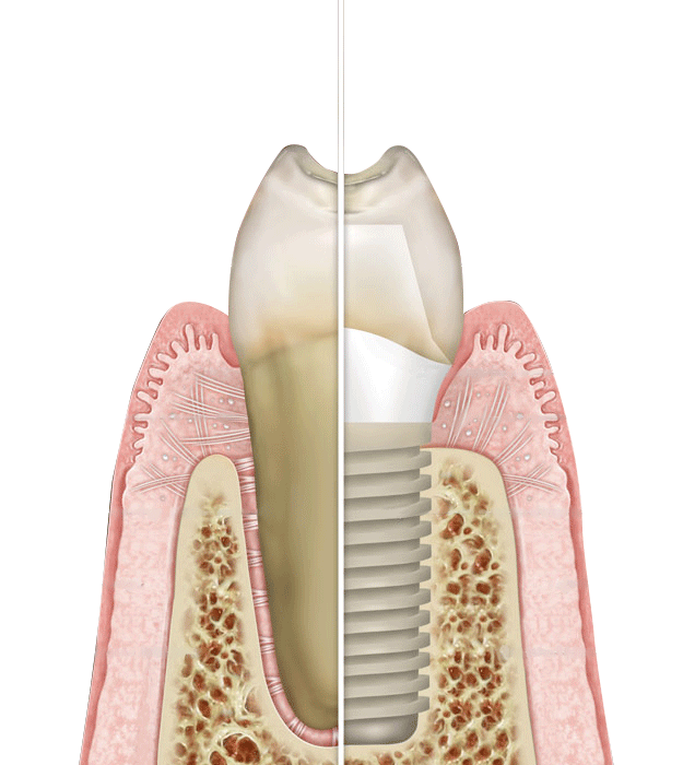 implant dentaire prix maroc